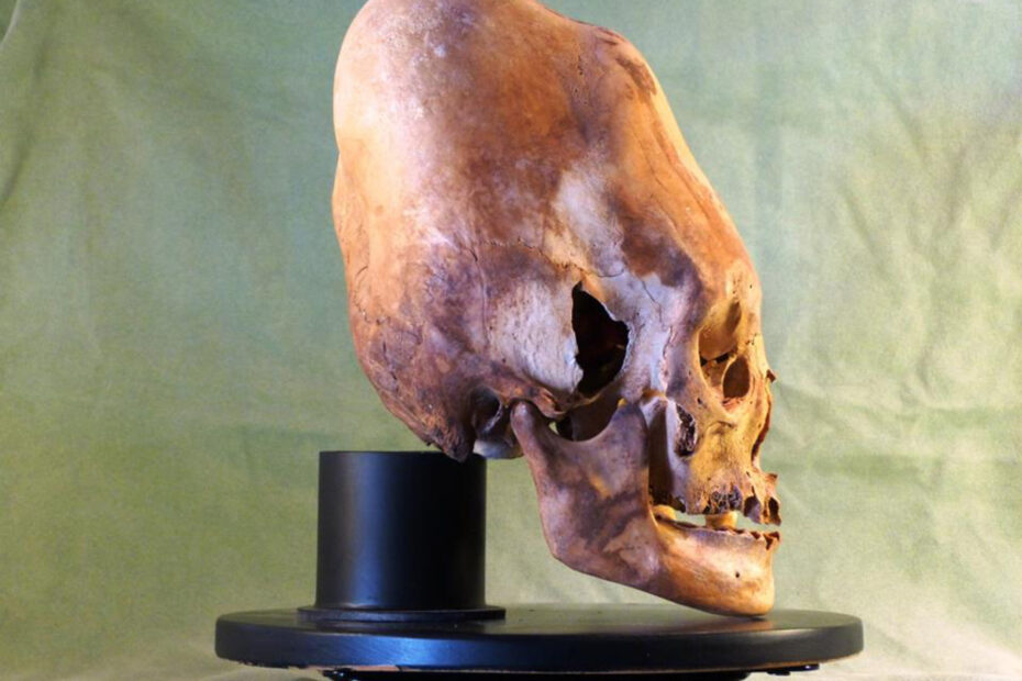 Cranial Deformation - Elongated Skull